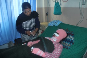 Acid attack victim Sangita Magar